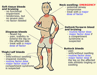 Hemophilia-Symptoms
